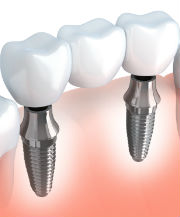 Implants | Dr. Tebay and Associates | Dentist Vienna, WV