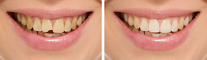 Restorative Dentistry | Dr. Tebay and Associates | Dentist Vienna, WV