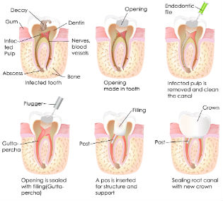 Root Canals | Dr. Tebay and Associates | Dentist Petersburg, WV